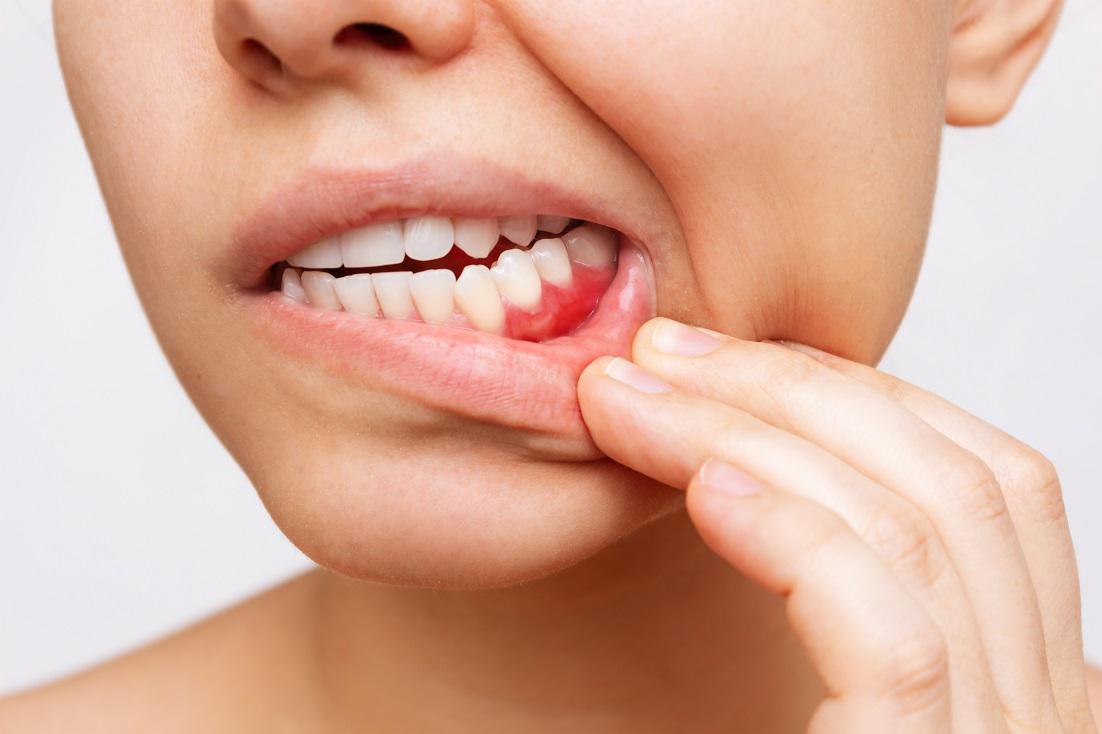 How Sugar Fuels the Fire of Gum Disease