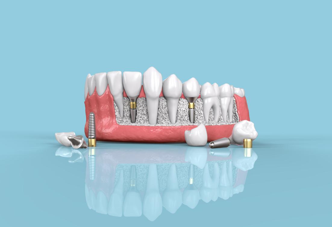 Dental Implants Lutherville-Timonium, MD
