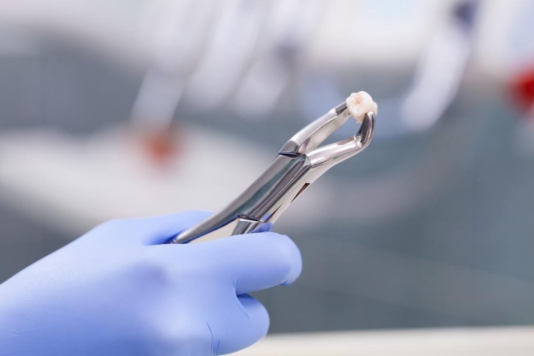 Toothe Extraction Lutherville-TImonium, MD