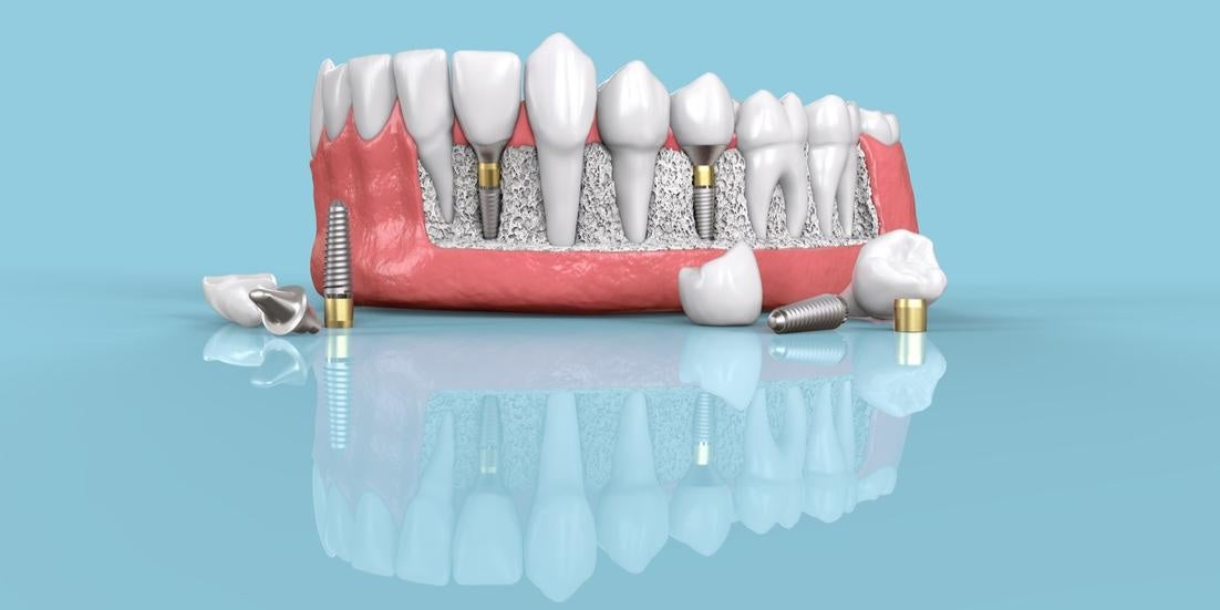 Dental Implants Lutherville Timonium MD Dental Implants Lutherville-Timonium, MD