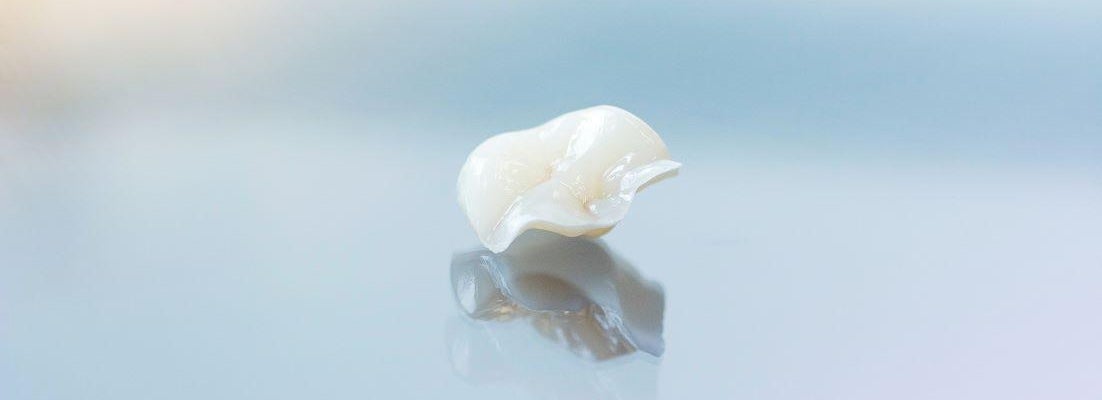 Inlays and onlays in Timonium, MD