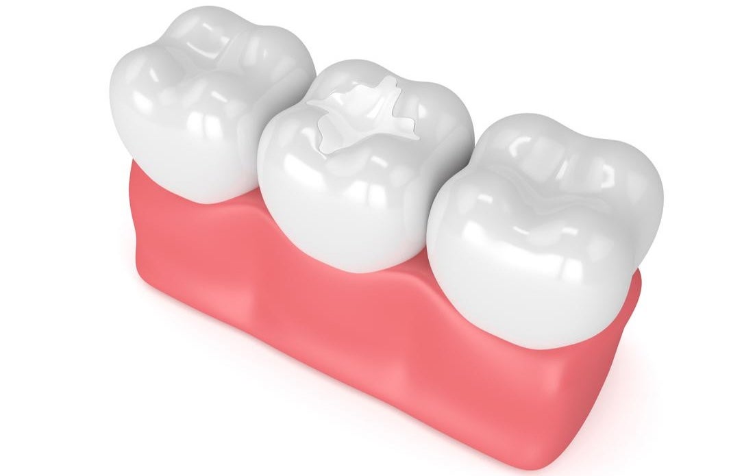 Composite Fillings in Timonium, MD